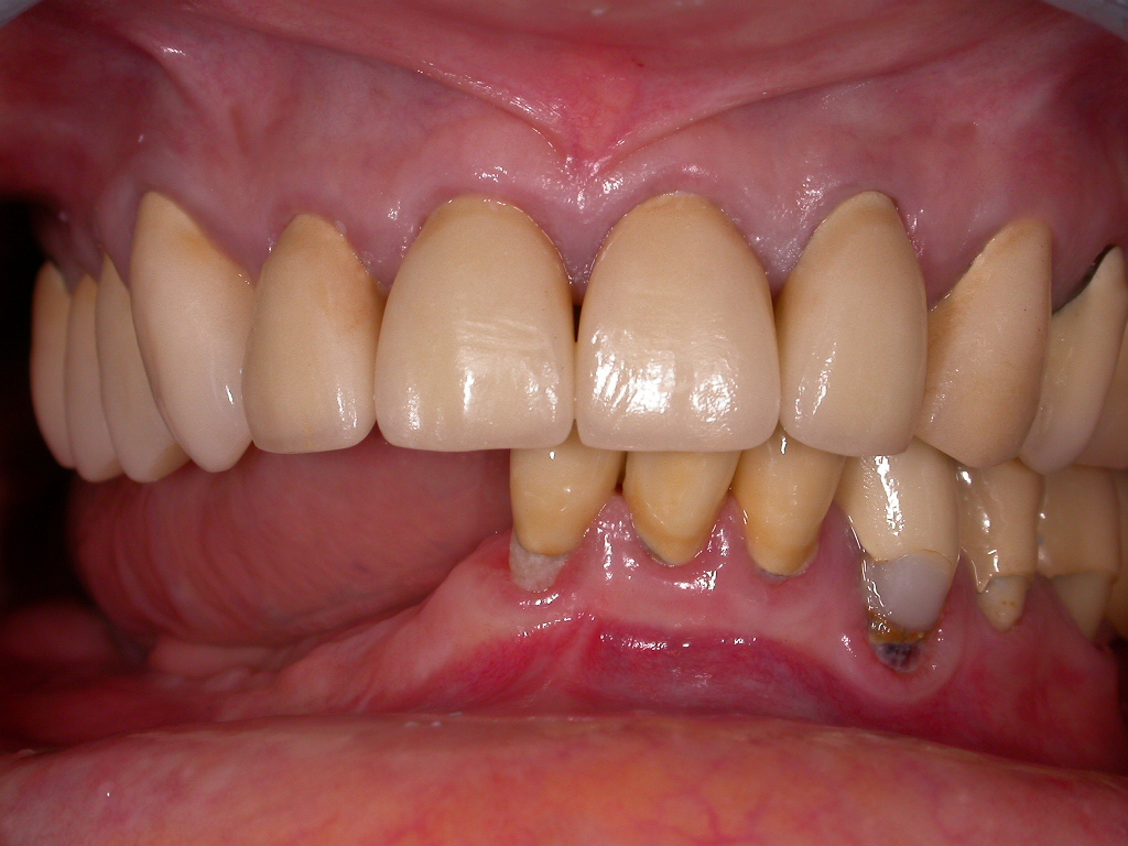 gescheiterte Implantat-Versuche und künstlich aussehende, leblose Kronen